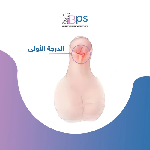 رسم يوضح موضع فتحة البول في الإحليل السفلي من الدرجة الأولى