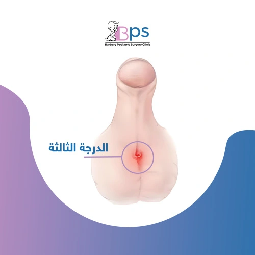 رسم يوضح موضع فتحة البول في الإحليل السفلي من الدرجة الثالثة