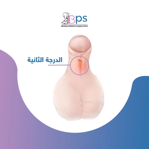 رسم يوضح موضع فتحة البول في الإحليل السفلي من الدرجة الثانية